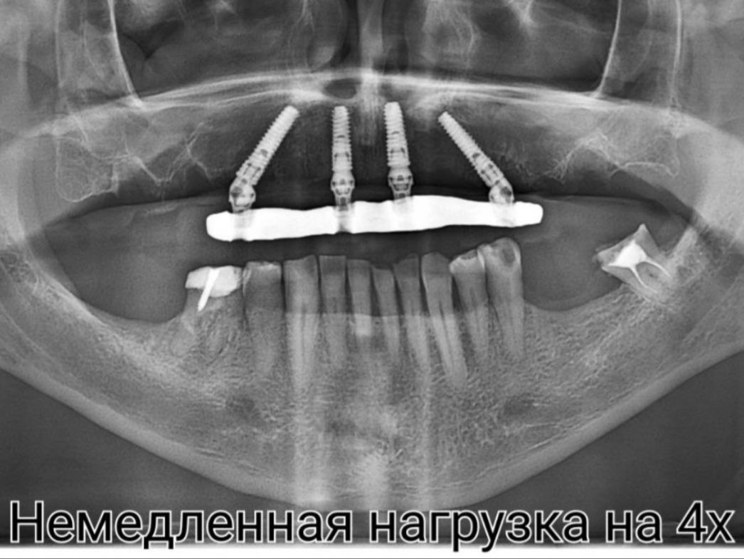 All-on-4 на верхней челюсти