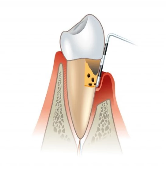 Кюретаж пародонтальных карманов в области 1 зуба (закрытый)