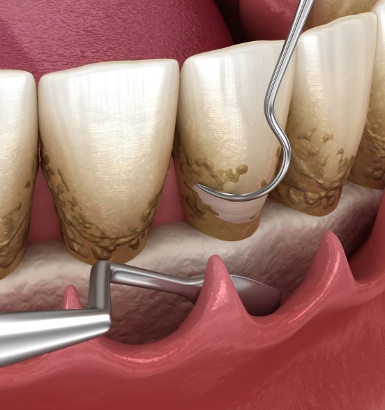 Пародонтологическая чистка