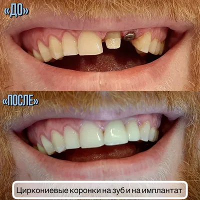 Циркониевые коронки на зуб и на имплантат