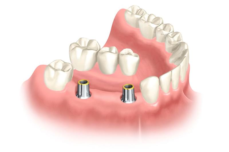 Зубной мост на имплантах